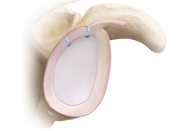 Arthrex - ShaverDrill for Short 2.9 mm PushLock, Hard Bone